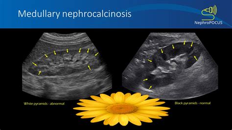 capture-3 – NephroPOCUS