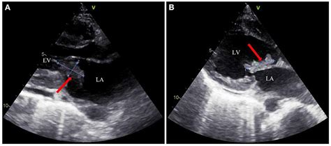 Frontiers | Abiotrophia defectiva causing infective endocarditis with brain infarction and ...