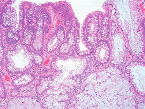 Sessile serrated adenoma with high-grade dysplasia. Nuclear alterations... | Download Scientific ...