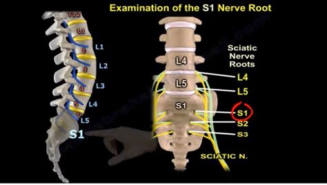 Examination Of S1 Nerve Root — OrthopaedicPrinciples.com