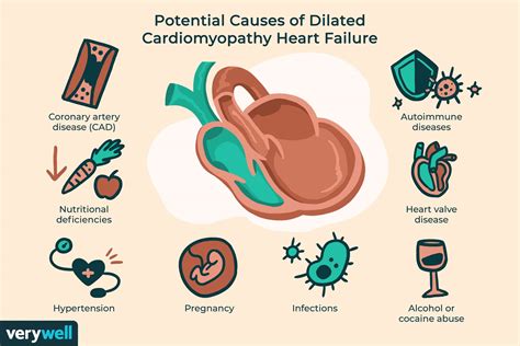 Dilated Cardiomyopathy Symptoms, Causes, Diagnosis, and Treatment