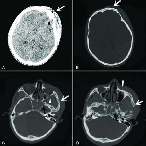 Pre-life CT findings. (A) Left frontotemporal epidural hematoma (black... | Download Scientific ...