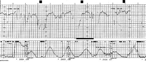 Figure 1 from Update on uterine tachysystole | Semantic Scholar