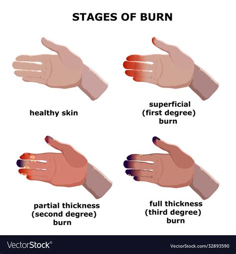 3rd Degree Burns On Fingers