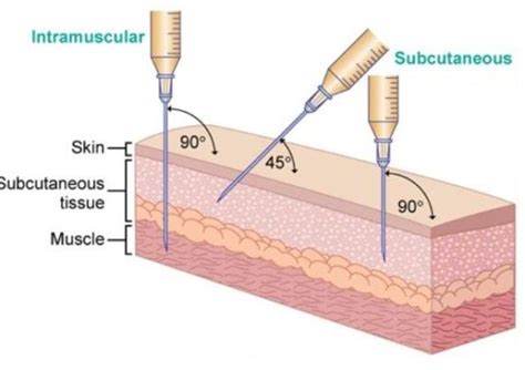 Subcutaneous Testosterone Injections Are Effective for TRT - ExcelMale