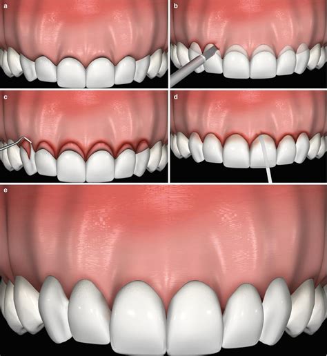 Laser Gum Treatment - Normanhurst Dental