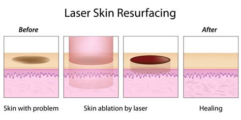 Laser Skin Resurfacing - AnewSkin Aesthetic Clinic and Medical Spa D.C