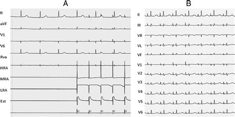 Atrial standstill - International Journal of Cardiology