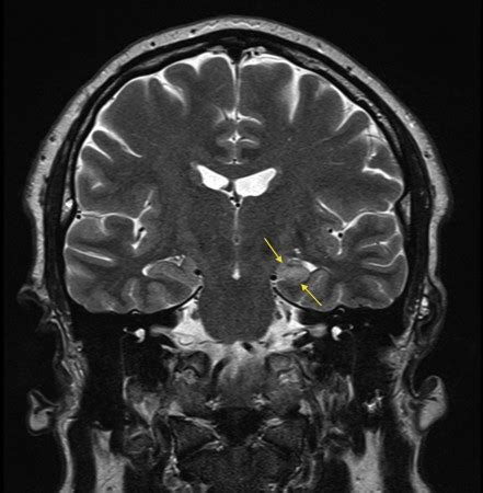 Mesial temporal sclerosis - Radiology at St. Vincent's University Hospital