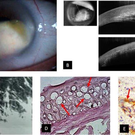 One-week after central penetrating keratoplasty | Download Scientific ...