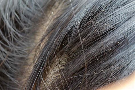 What Does Lice Look Like? Pictures of Nits, Eggs & Lice - Verywell Health