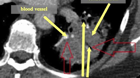 air bronchograms on a CT of the thorax - YouTube