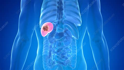 Spleen cancer, illustration - Stock Image - F035/2584 - Science Photo Library