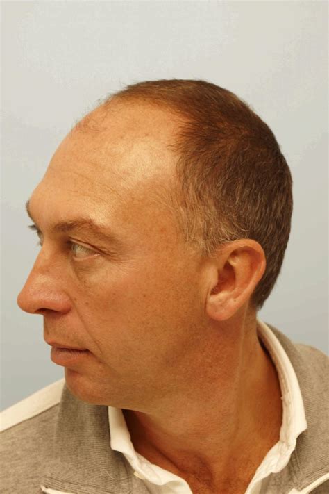 David Platt hair transplant - Mirror Online