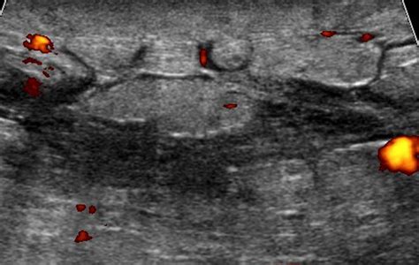 Inflammatory Breast Cancer Ultrasound