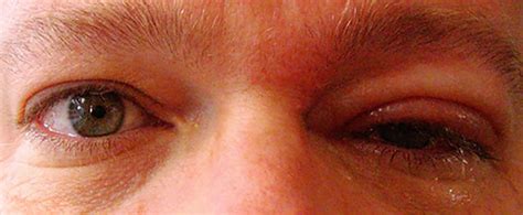 Shingles In The Eye: Symptoms, Causes and Treatments