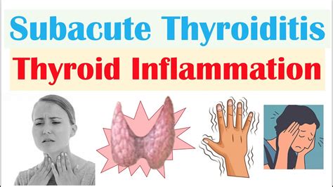 Subacute Thyroiditis (Thyroid Inflammation; De Quervain’s) | Causes ...