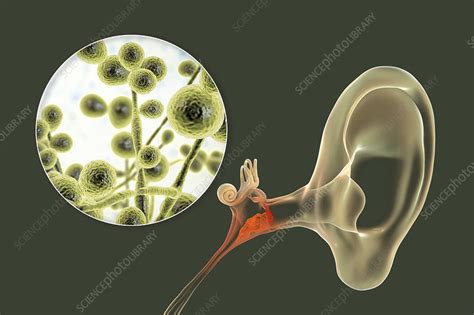 Chronic fungal otitis media ear infection, illustration - Stock Image - F032/5963 - Science ...