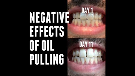 OIL PULLING EXPERIMENTS - Negative/Side Effects | Day 11 - YouTube