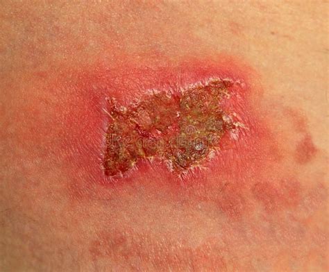 Large Healing Scab Stock Photo - Image: 40213163