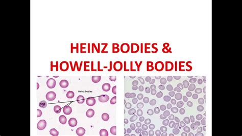 HEINZ BODIES and HOWELL-JOLLY BODIES - YouTube