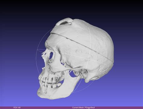 Phineas Gage Skull, harvard CT SCAN, Museum Quality High Resolution STL ...