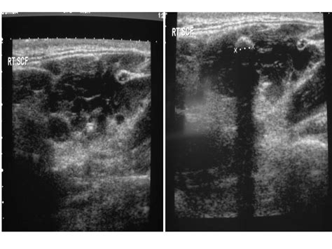 Vascular Malformations | BSIR