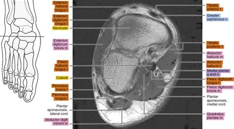 MRI of the foot | Radiology Key