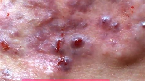 Pimple Popping on face Remove Cystic on face | blackhead Acne VIP - YouTube