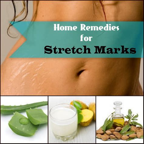 Home Remedies for Stretch Marks – Now No Ugly Notch