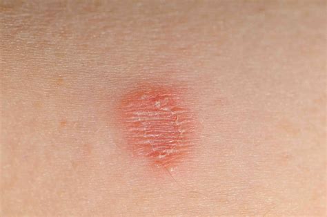 Ringworm: Causes, Signs Based on Skin Color, and Treatment