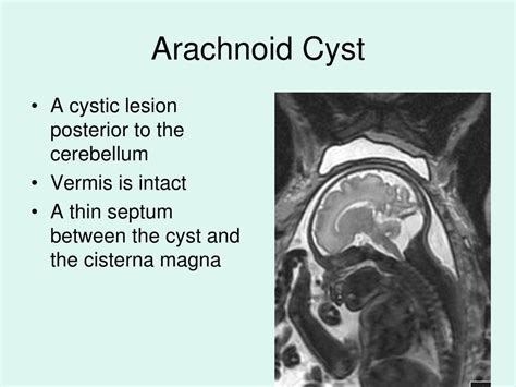 PPT - Anomalies of the Posterior Fossa and the Spinal Cord- Fetal MRI ...