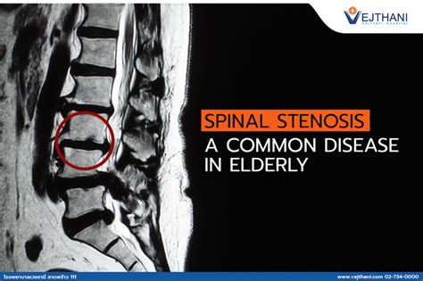 Spinal Stenosis – A Common Disease in Elderly