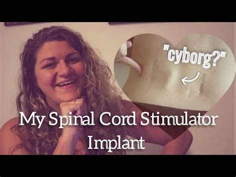 Abbott spinal cord stimulator - bingerbm