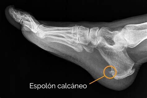 Espolón calcáneo: causas, síntomas, tratamiento y ejercicios