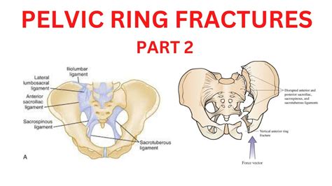 PELVIC RING FRACTURES - PART 1 - EPISODE 1 - YouTube