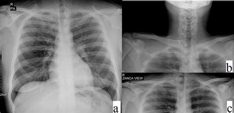 Initial radiographies including chest X ray (a), Serendipity (b) and... | Download Scientific ...