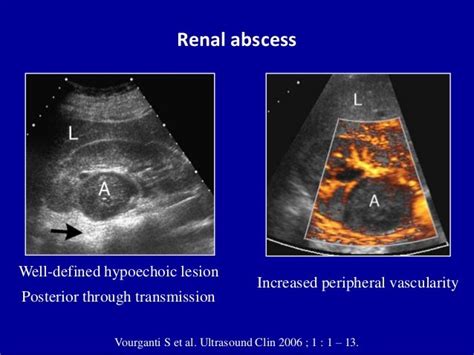 Ultrasound of the urinary tract - Renal infections