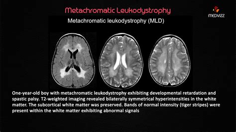 Metachromatic Leukodystrophy - USMLE Biochemistry webinar Case based lecture - YouTube