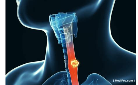 Esophageal Cancer Surgery: Treatment for Esophageal Cancer