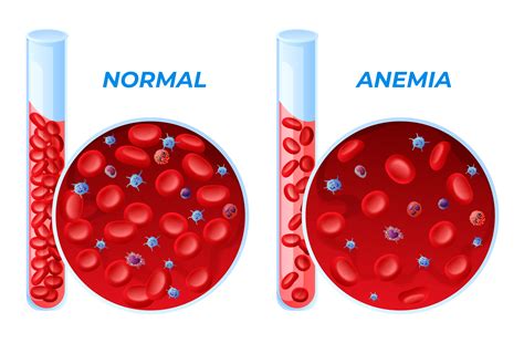 Anaemia During Pregnancy: Types, Causes, and Treatments | Healthengine Blog