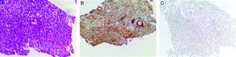 Histopathology shows a thymic tumor exhibiting epithelial islands that... | Download Scientific ...