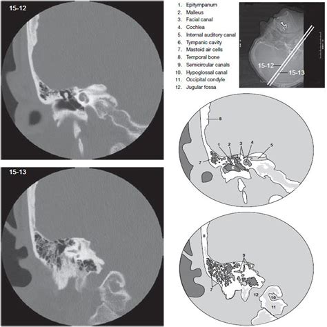 Temporal Bone - CT Scan - RadTechOnDuty