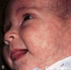 Cutis Marmorata | Kids pictures, Skin, Newborn