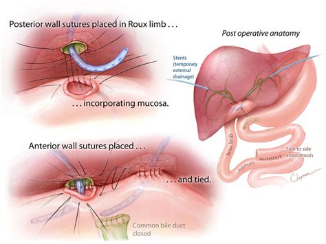 Hepaticojejunostomy After Iatrogenic Biliary Injury. Watercolor and Adobe Photoshop ...