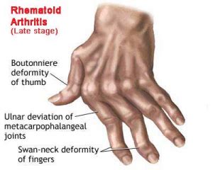 rheumatoid arthritis normal life expectancy - Renae Wolff