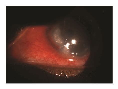 (a) Right eye slit lamp photo showing a large corneal infiltrate with a ...