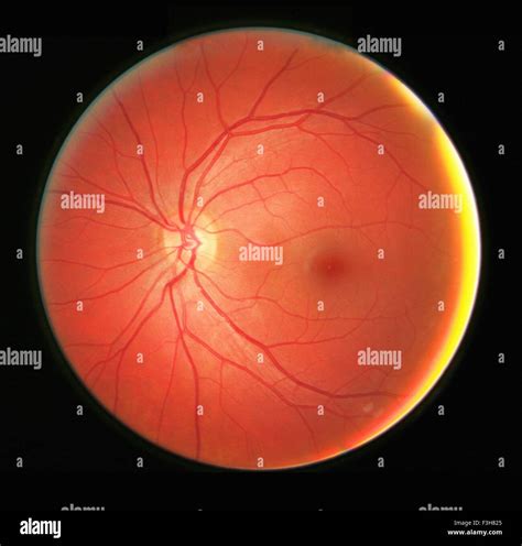 Fundus photograph of the left eye, showing the retina, macula, fovea and related structures ...