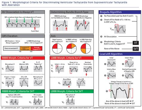 Wide Complex Tachycardia - Ventricular Tachycardia or Not Ventricular Tachycardia, That Remains ...