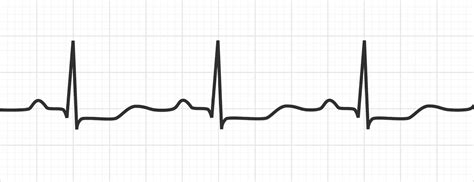 Hypokalemia Ecg